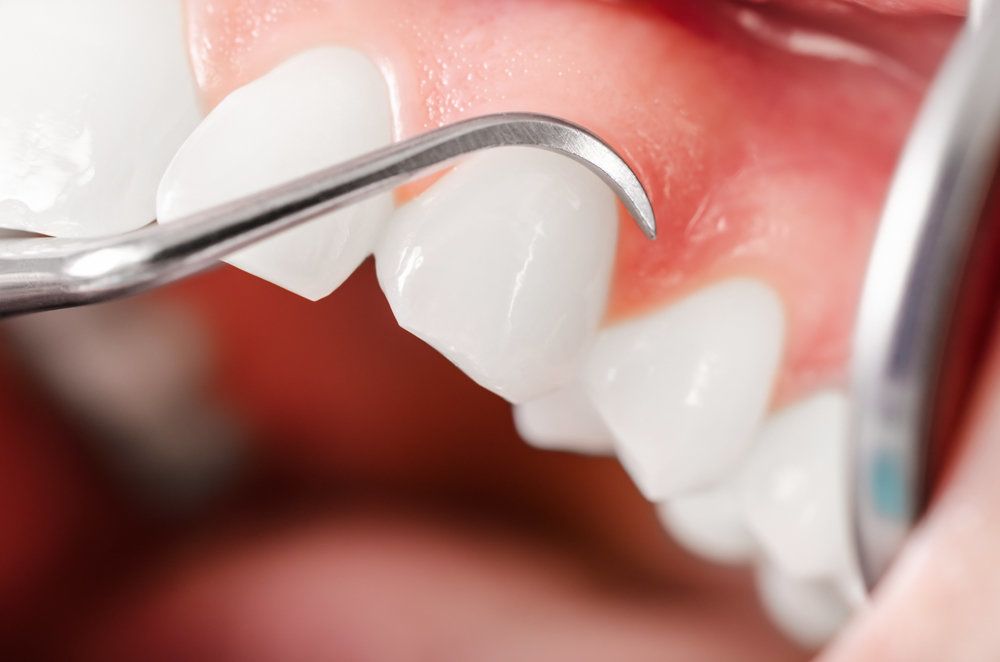 Tartar scraper tool cleaning teeth